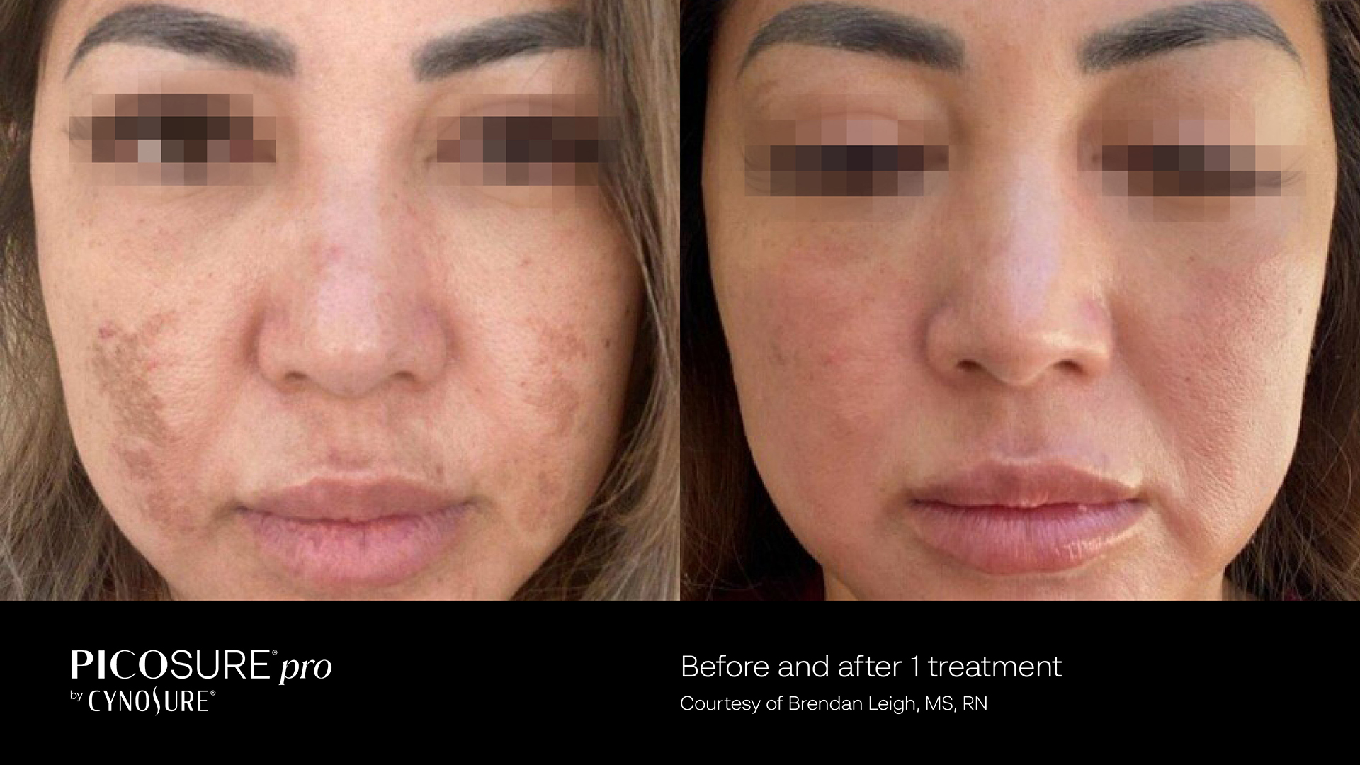 PicoSure Pro laser reducing visible skin imperfections.