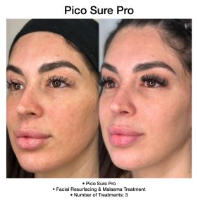 PicoSure Pro laser results targeting sun damage and dark spots.